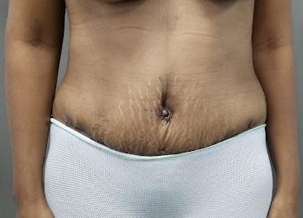 Tummy Tuck After